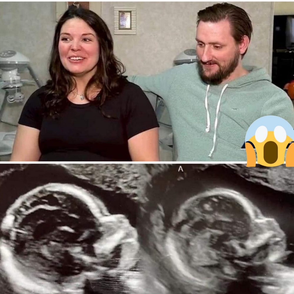 Una mujer que posee dos úteros esta embarazada de gemelas, una en cada uno de sus úteros.