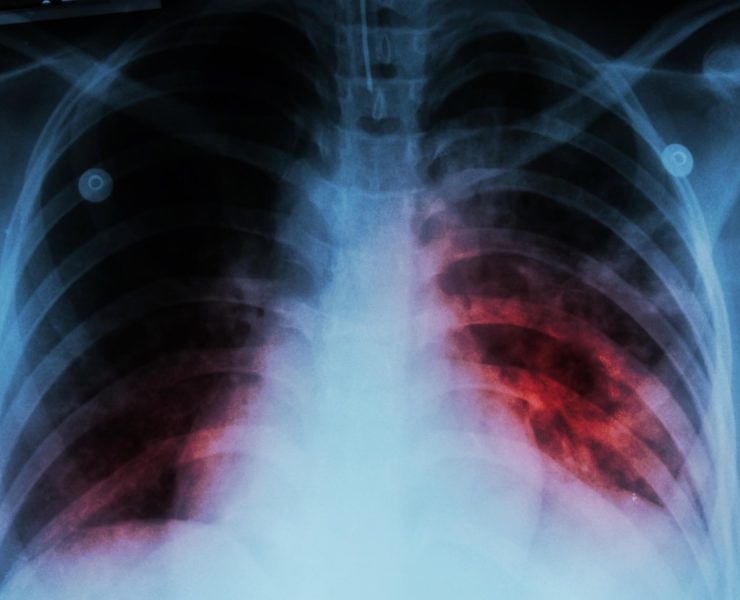 Llaman a prevenir la tuberculosis