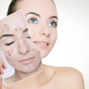 Descubren nuevo tratamiento para el acné