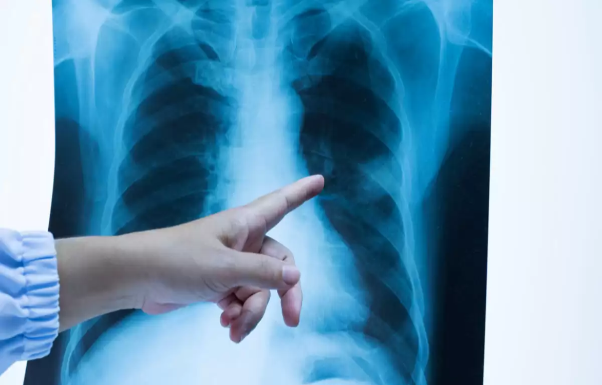 Pocos casos de tuberculosis en Campeche
