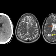 Un hombre tenía solitarias en el cerebro