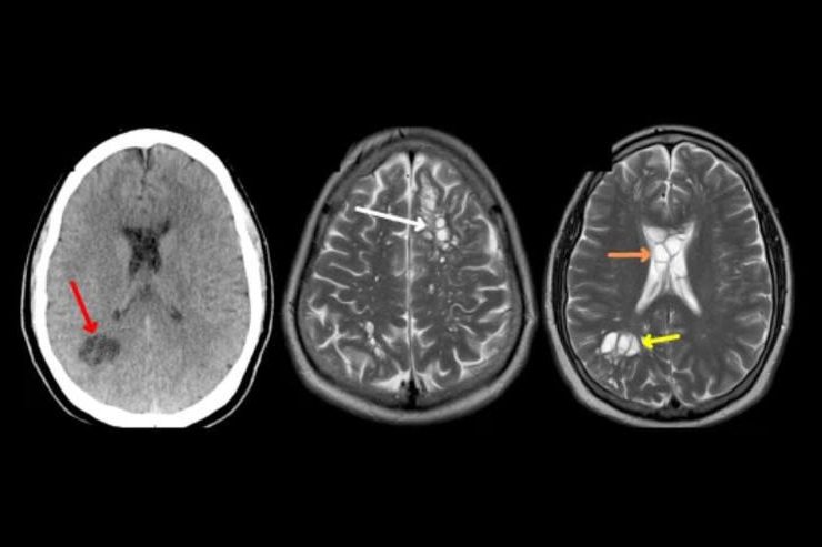 Un hombre tenía solitarias en el cerebro