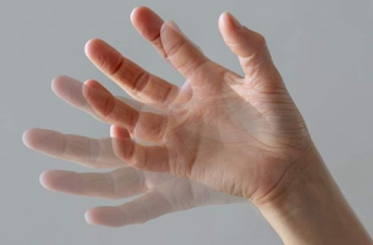 El Parkinson enfermedad neurodegenerativa ¿Qué sabemos de esta enfermedad?