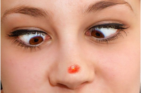 Un joven sufre infección cerebral por un grano