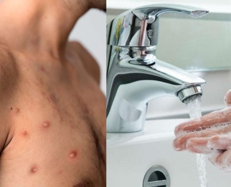 La Viruela del Mono o Mpox, sigue en aumento en el mundo, por lo que te decimos como protegerse del contagio de esta enfermedad.