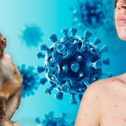 Aumento de Viruela de Mono en Yucatán: ¿Qué Está Sucediendo?