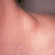 Linfoma de Hodgkin en Yucatán: Un Estudio Revelador