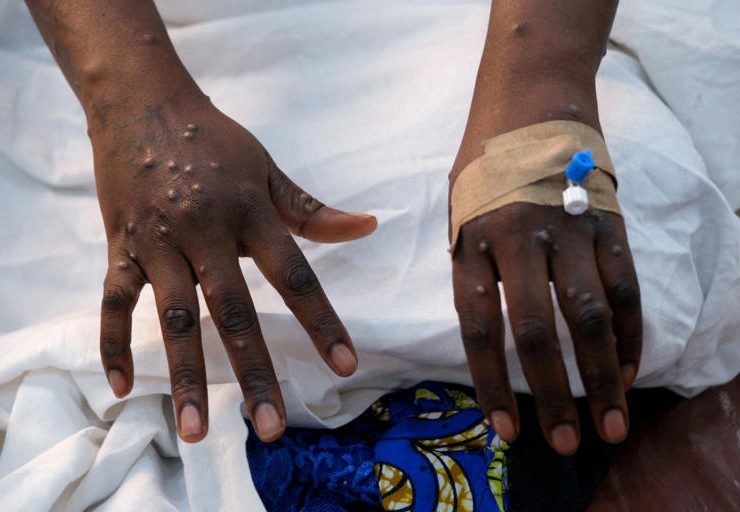 Primer caso de Viruela del Mono en Alemania: Alerta Sanitaria