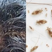 Vídeos Impactantes de Niña con Piojos