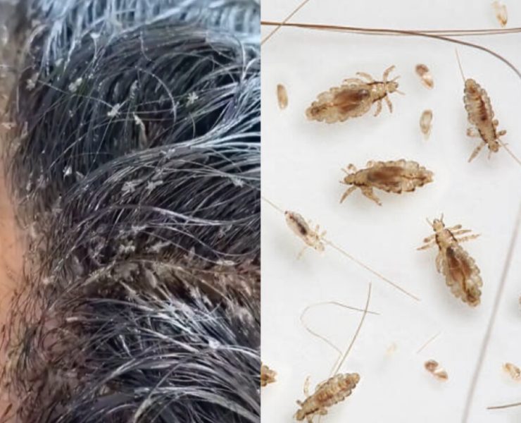 Vídeos Impactantes de Niña con Piojos