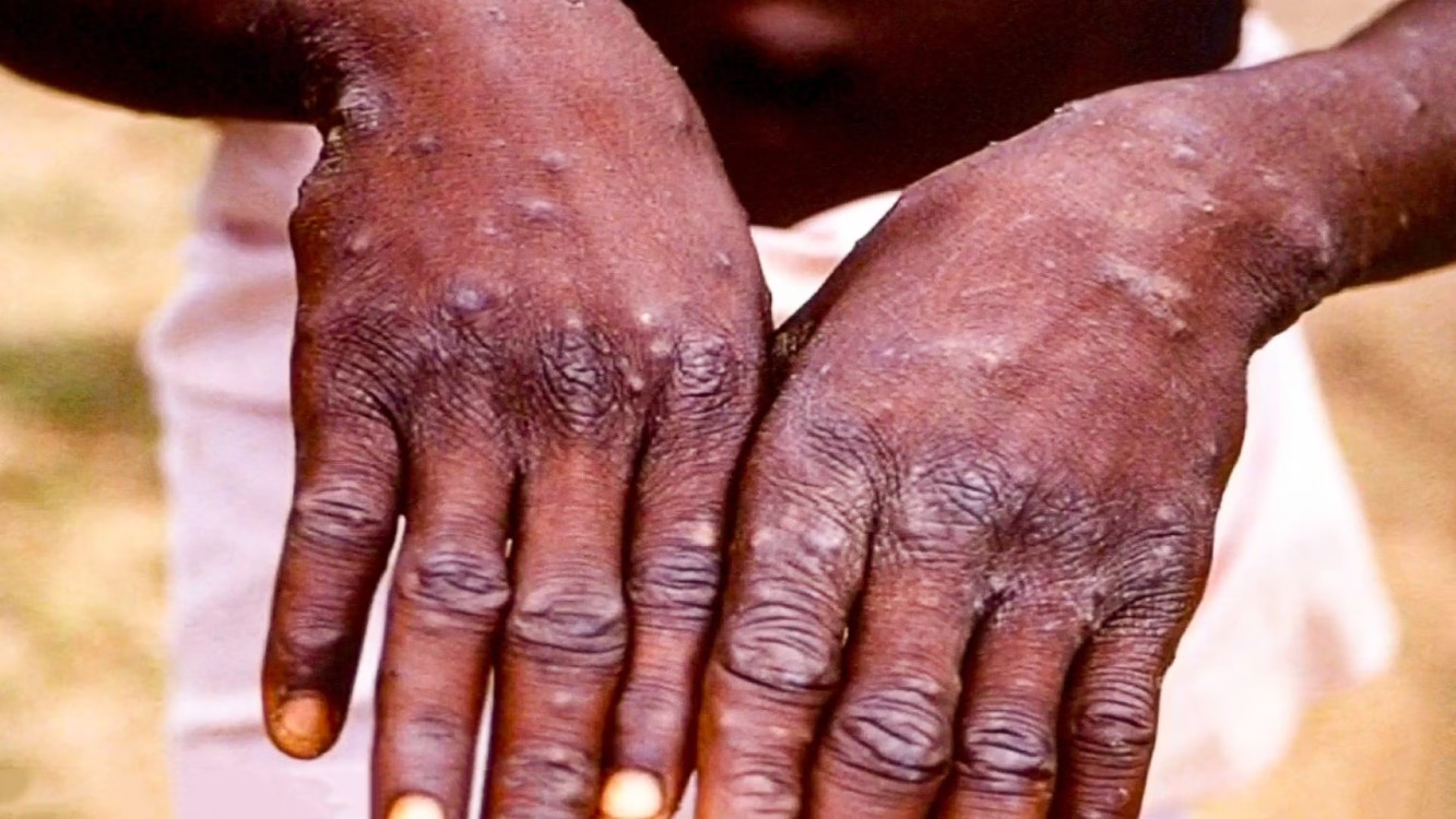 Medidas de Prevención y Tratamiento para Niños