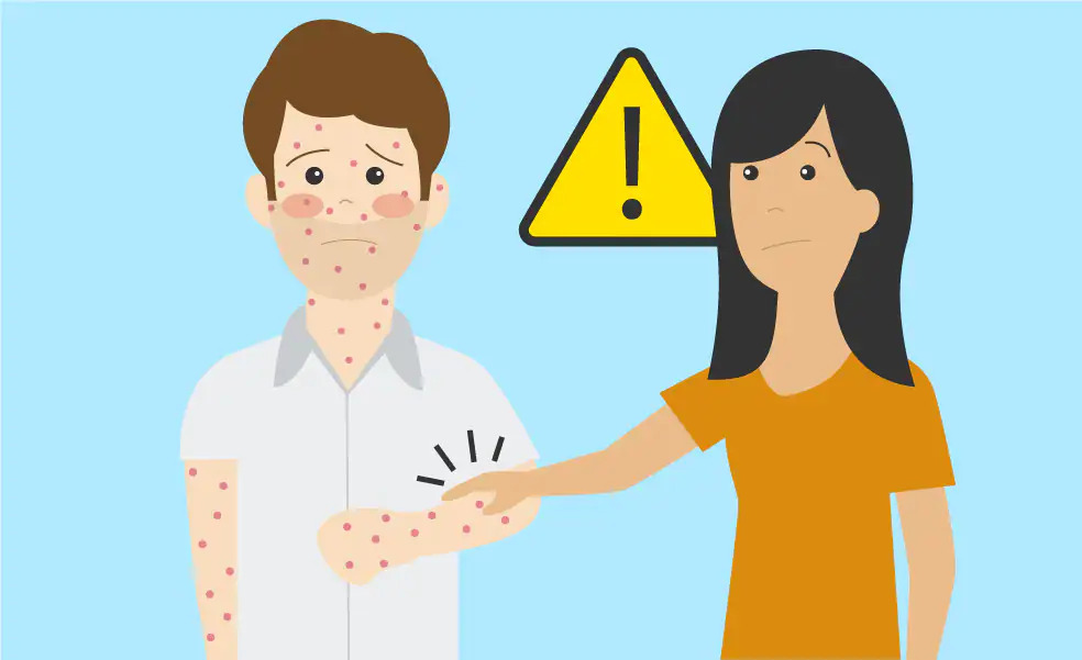 Síntomas de la Viruela del Mono en Niños