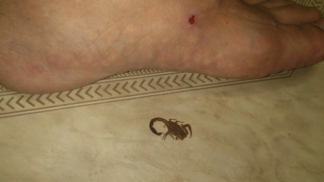 Primeros auxilios en caso de picadura de alacrán en Mérida