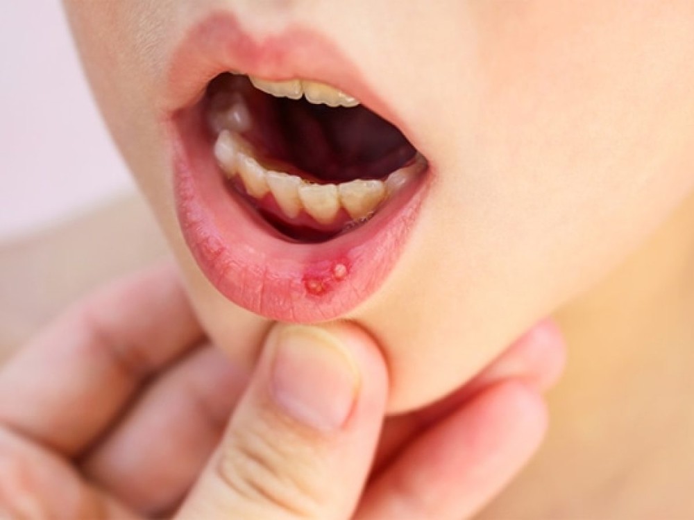 Coordinación de Salud Municipal no ha atendido casos de coxsackie