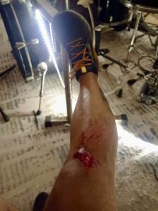 Los delincuentes, alcanzaron a dejarle una herida en una de las piernas de Adrián Nah, mientras intentaban asaltarlo en Chenkú.