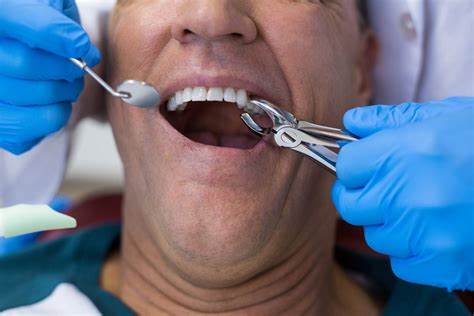 ¿Qué es el gel capaz de remover caries?