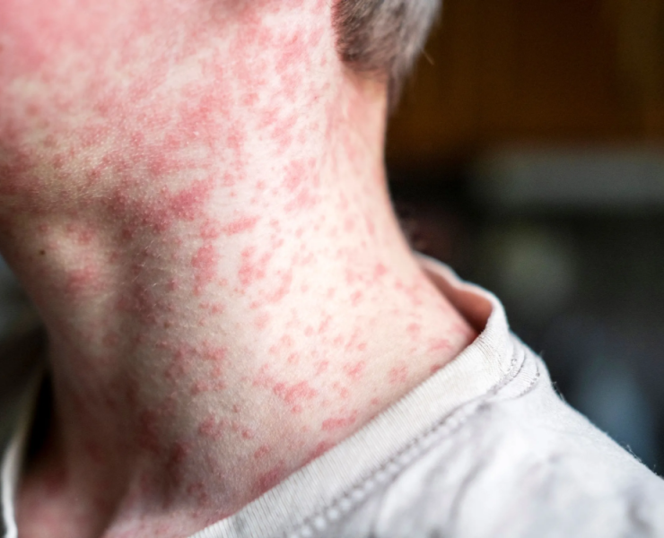 Muerte por Sarampión en Estados Unidos