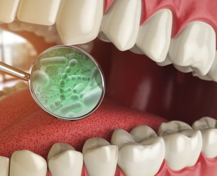 Las bacterias bucales y el alzhéimer tienen una fuerte relación