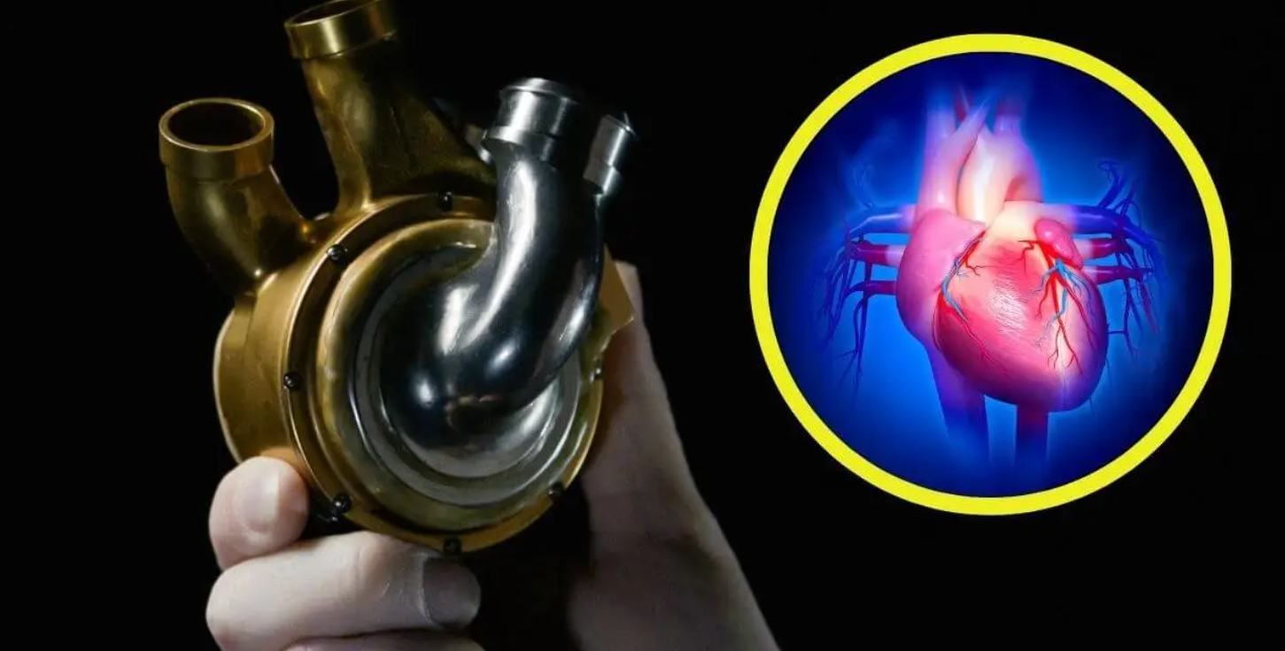 Paciente vivió 100 días con corazón de titanio: Revolución médica