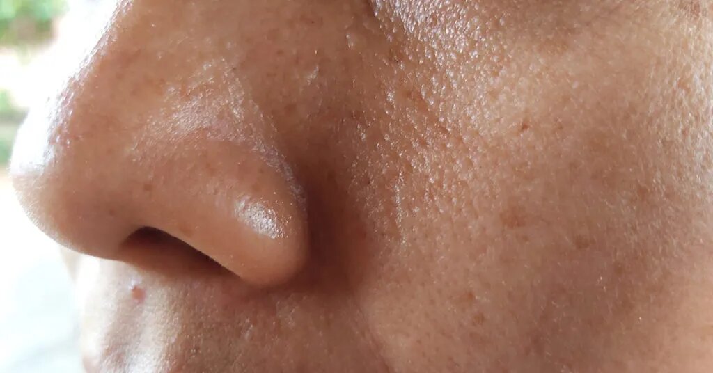 ¿Qué causa la piel grasa?