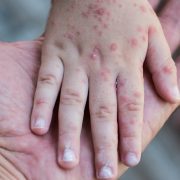 Detectan 20 casos de virus Coxsackie en Tabasco