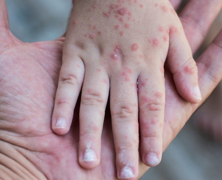 Detectan 20 casos de virus Coxsackie en Tabasco