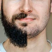 ¿Son los trasplantes de barba realmente efectivos? Descúbrelo ahora