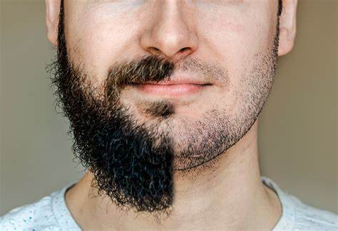 ¿Son los trasplantes de barba realmente efectivos? Descúbrelo ahora