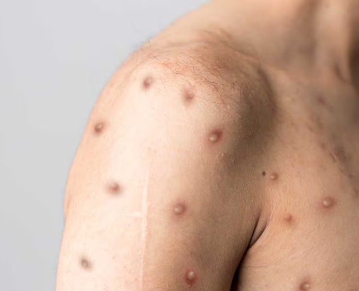 ¡Alerta Global! Mpox sigue siendo amenaza mundial según la OMS
