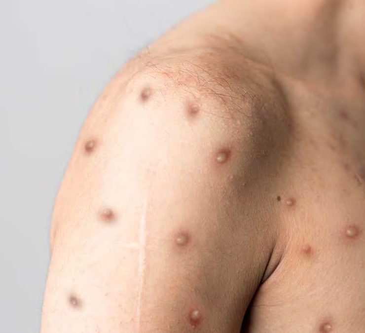 ¡Alerta Global! Mpox sigue siendo amenaza mundial según la OMS