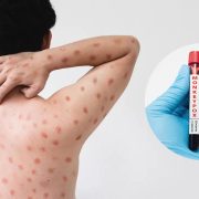 Reino Unido identifica 4 casos de mpox y enciende alarmas globales