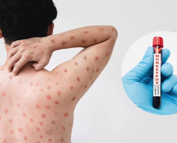 Reino Unido identifica 4 casos de mpox y enciende alarmas globales