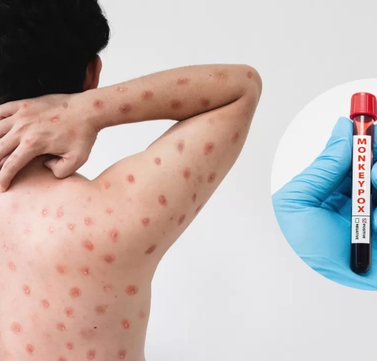 Reino Unido identifica 4 casos de mpox y enciende alarmas globales