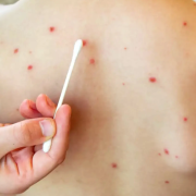 casos de sarampión en México