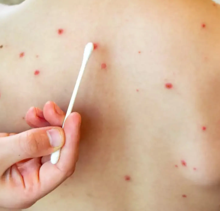 casos de sarampión en México