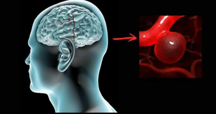 ¿Cómo funcionan los nano robots para reparar aneurismas?