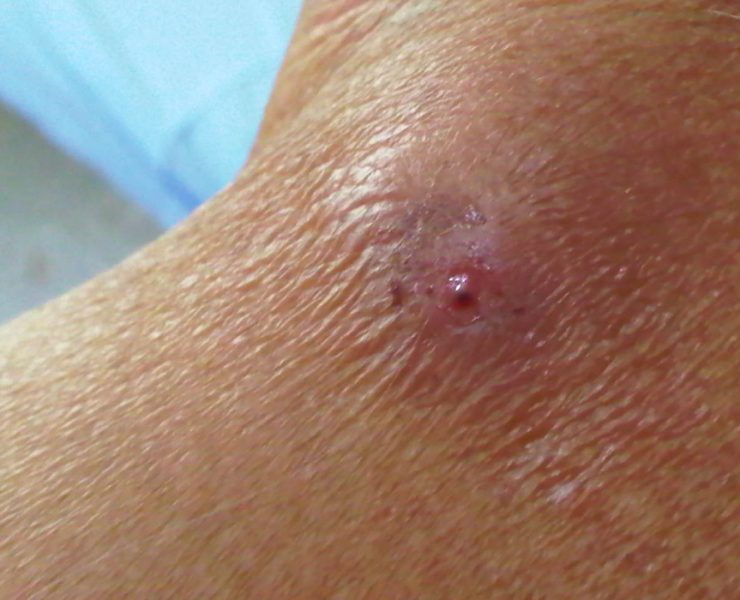 Debe preocupar a las autoridades de salud el caso de miasis humana