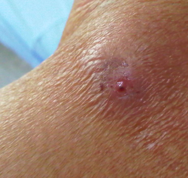 Debe preocupar a las autoridades de salud el caso de miasis humana