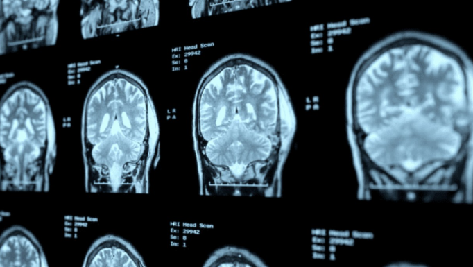 Alzheimer juvenil: un término que ya no es ciencia ficción
