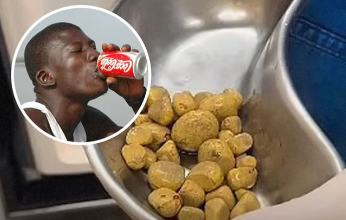 Hombre con 35 piedras en la vejiga por tomar Coca-Cola diariamente