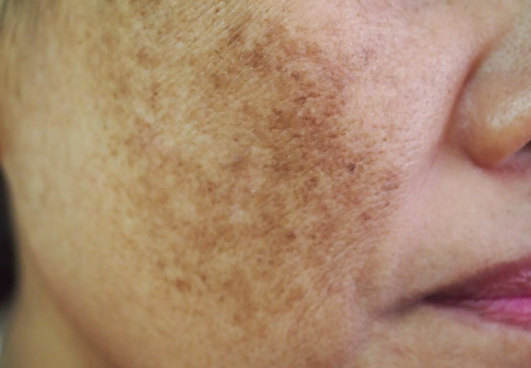Michelle Salas rompe el silencio: “vivo con melasma”