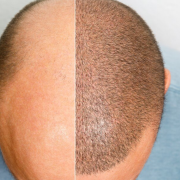 Científicos crean una cura para la calvicie causada por alopecia