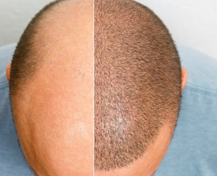 Científicos crean una cura para la calvicie causada por alopecia