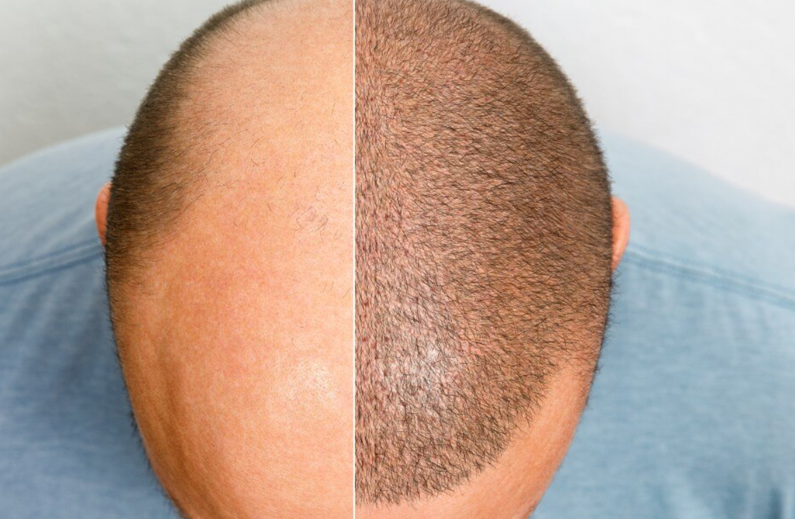 Científicos crean una cura para la calvicie causada por alopecia