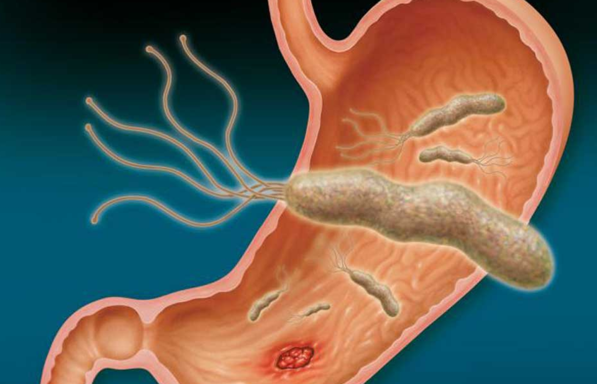 ¿Curan la gastritis? Científica elimina una bacteria que la causa