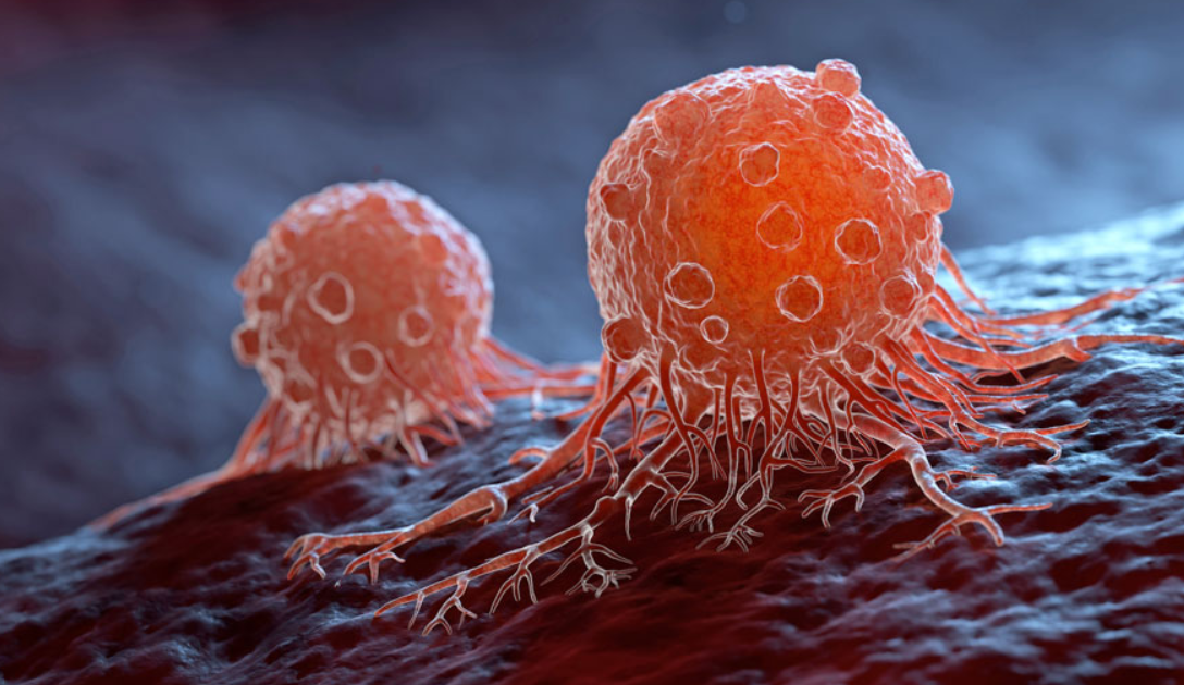 Un hombre descubre un raro cáncer, todo por que se fue a revisar una tos