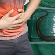Un hombre tenía una anguila viva dentro de su abdomen