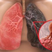 El cáncer de pulmón no distingue