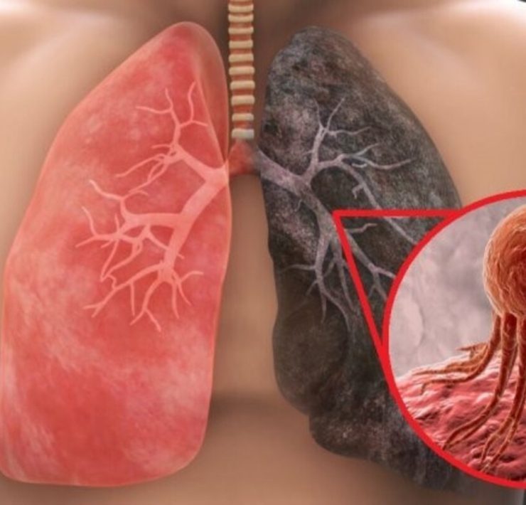 El cáncer de pulmón no distingue