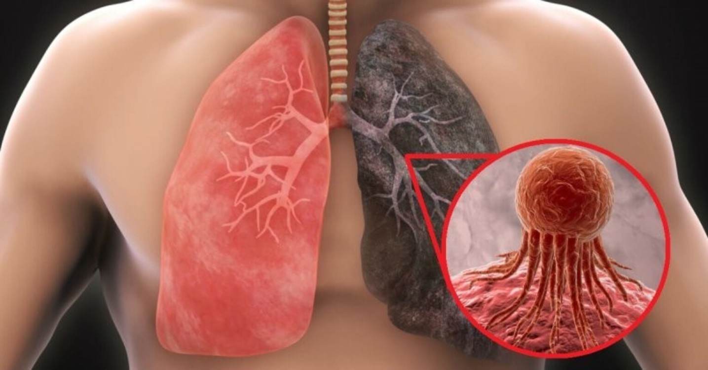 El cáncer de pulmón no distingue